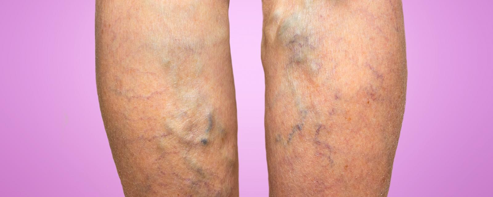 Five Myths About Spider and Varicose Veins - MercyOne Iowa Heart Vein Center